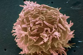 Giải pháp chữa trị ung thư đầu cổ