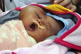 Xót lòng bé sơ sinh mang khối u hình trái tim