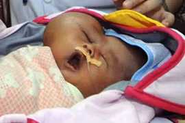 Xót lòng bé sơ sinh mang khối u hình trái tim