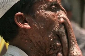 Nghịch cảnh người voi từ chối gương mặt đẹp để ăn xin