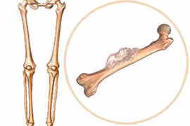 Những yếu tố gây bệnh ung thư xương