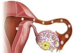 Cảnh báo mắc ung thư buồng trứng do kinh nguyệt không đều