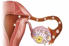Cảnh báo mắc ung thư buồng trứng do kinh nguyệt không đều