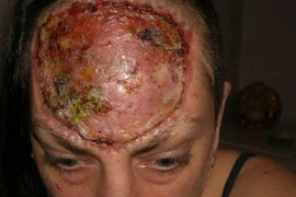 Cám cảnh bà mẹ gọt trán trị ung thư