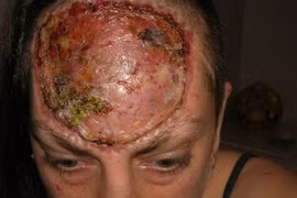 Cám cảnh bà mẹ gọt trán trị ung thư