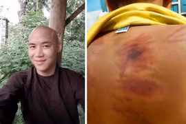 Thân thể bé trai 11 tuổi rướm máu, lở loét vì bị thầy chùa đánh đập dã man