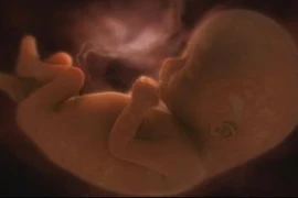 Nước ối chữa viêm ruột hoại tử cho trẻ sơ sinh