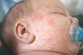 Trẻ phát ban nên xử lý thế nào?