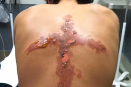 “Thách thức muối và băng” thú vui dại dột của tuổi teen