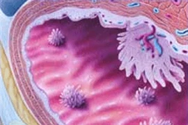 “Hung thủ” gây ung thư bàng quang ở chị em