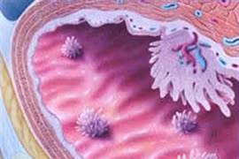 “Hung thủ” gây ung thư bàng quang ở chị em