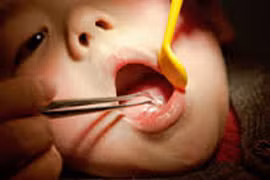 Dễ tắc ruột, nghẹt thở khi trẻ nuốt kẹo cao su