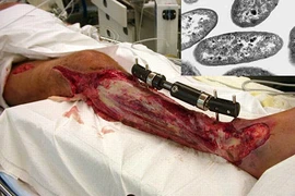 Sự thật đáng sợ về vi khuẩn “ăn thịt người“