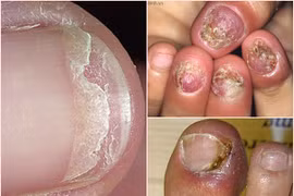 Hành trình ghê rợn từ móng đẹp đến móng... thối