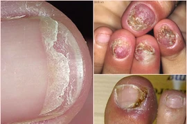 Hành trình ghê rợn từ móng đẹp đến móng... thối