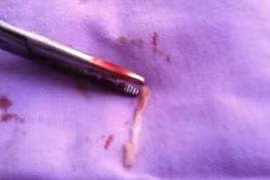 Hi hữu bệnh nhân bị sán làm “ổ” trong đùi