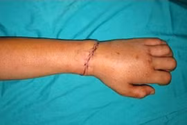 Mâu thuẫn “trẻ con”, một học sinh bị chém lìa tay