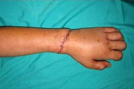 Mâu thuẫn “trẻ con”, một học sinh bị chém lìa tay