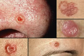 “Sát thủ” của làn da khi hè về