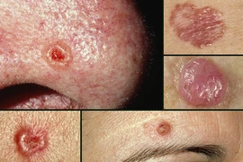 “Sát thủ” của làn da khi hè về