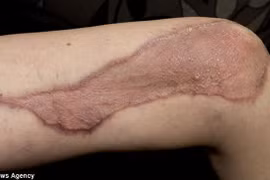 Bị vi khuẩn ăn cụt tay, chân khi đi dã ngoại