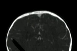 Bút chì 13cm đâm qua mắt vào não bé 19 tháng tuổi