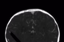 Bút chì 13cm đâm qua mắt vào não bé 19 tháng tuổi