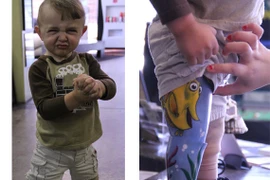 “Hình xăm” siêu cute của bé 2 tuổi mang chân giả