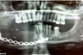 Cấy dây xích vào hàm để thay răng