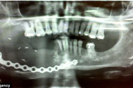 Cấy dây xích vào hàm để thay răng