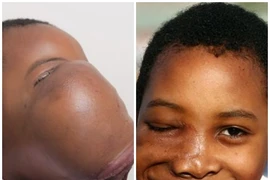 Nụ cười của cô bé có khối u 2kg trên mặt