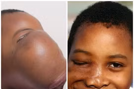 Nụ cười của cô bé có khối u 2kg trên mặt