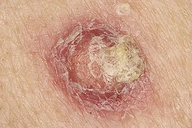 Những dấu hiệu ung thư da không thể bỏ qua