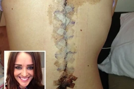 Phục hồi kỳ diệu sau 10 ngày gãy cột sống