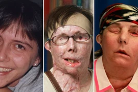 Khuôn mặt mới của người phụ nữ bị tạt acid