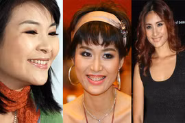 Những hàm răng “thế hệ tetracycline” của sao Việt