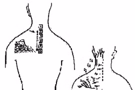 Tự chẩn đoán thoái hóa cột sống cổ