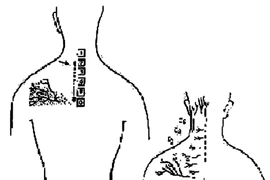 Tự chẩn đoán thoái hóa cột sống cổ