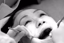 Mổ u tuyến nước bọt gây liệt mặt?