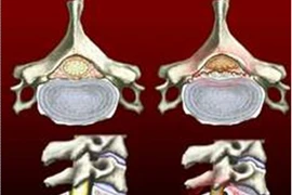 Đau chân khi đi bộ: dấu hiệu bị liệt chi