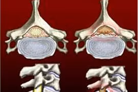 Đau chân khi đi bộ: dấu hiệu bị liệt chi