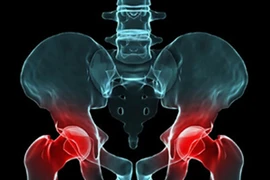 Viêm cột sống dính khớp dễ bị liệt tứ chi, lao phổi