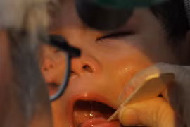 Bé sơ sinh viêm ruột vì bôi lá hẹ lên nướu