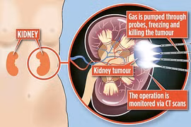 Chữa ung thư thận bằng cách đóng băng khối u