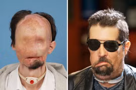 Thần kỳ những ca tái tạo mặt “quái nhân“