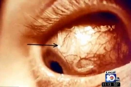 Clip teen Anh nguy cơ bị mù do kính áp tròng