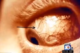 Clip teen Anh nguy cơ bị mù do kính áp tròng