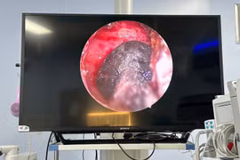 Đau vùng đỉnh đầu bên phải, đi khám phát hiện nấm xoang bướm