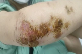 Nhiễm khuẩn, phù nề sau khi tắm bằng thuốc nam