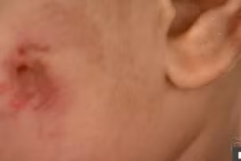 Bé 17 tháng kín vết cắn trên người, lời giải thích của cô giáo càng "dậy sóng"